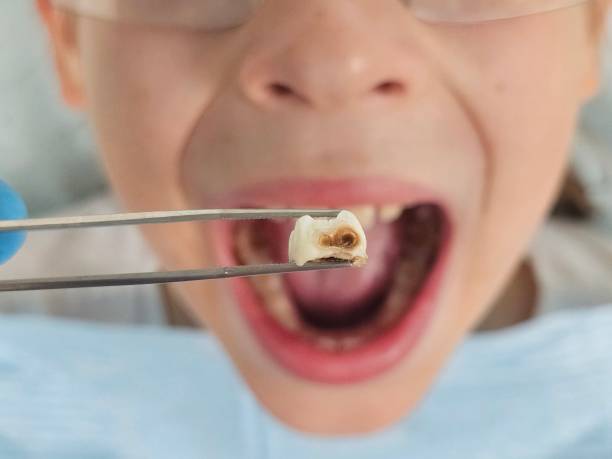 Best Emergency Tooth Extraction in Lodi, OH